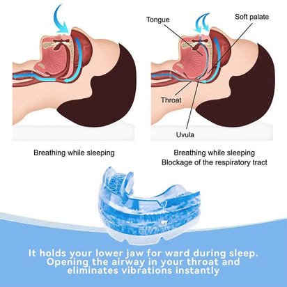 Nights Anti-Snoring Mouthpiece